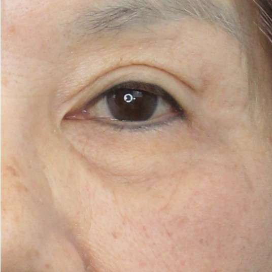 後-Eyebag nonsurgical
