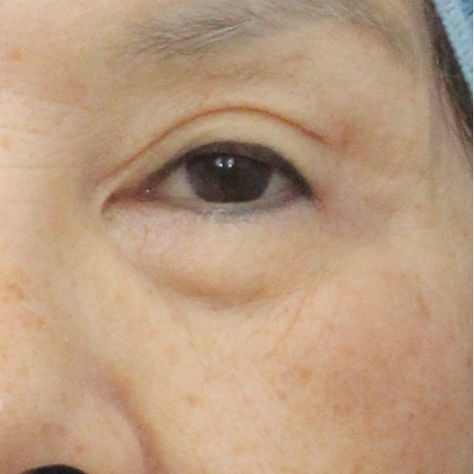前-Eyebag nonsurgical