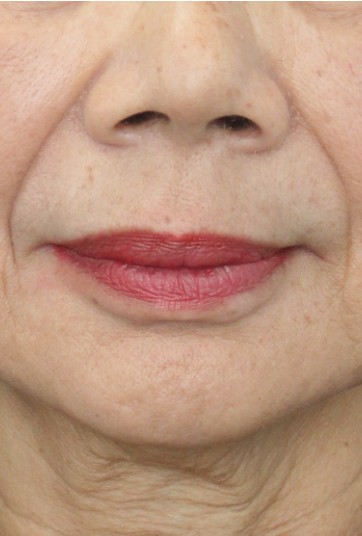後-Chin Filler