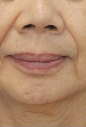 前-Chin Filler