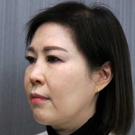 後-instant lift 3