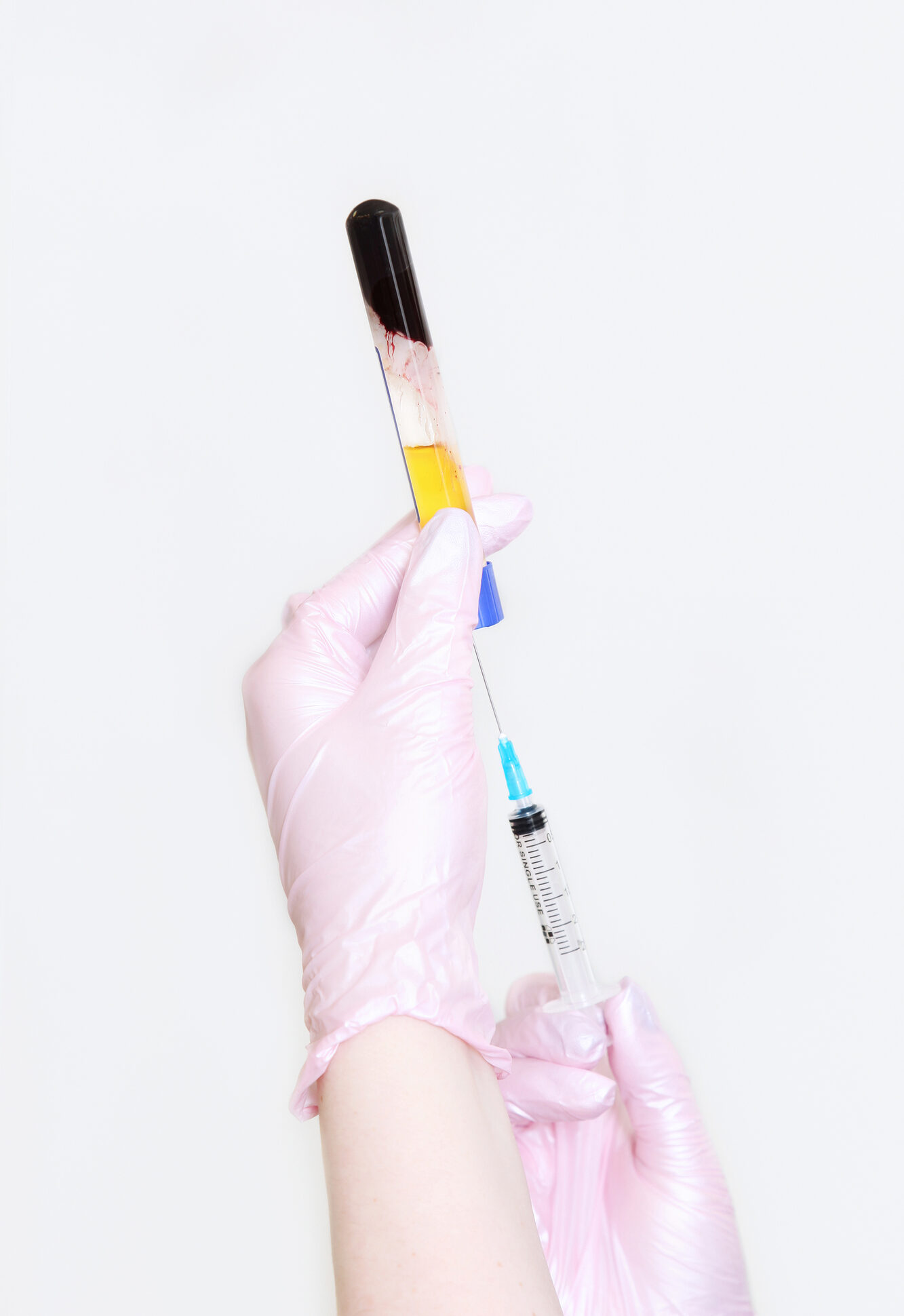 Test tube in his hands with blood plasma and syringe in his hand for injection.