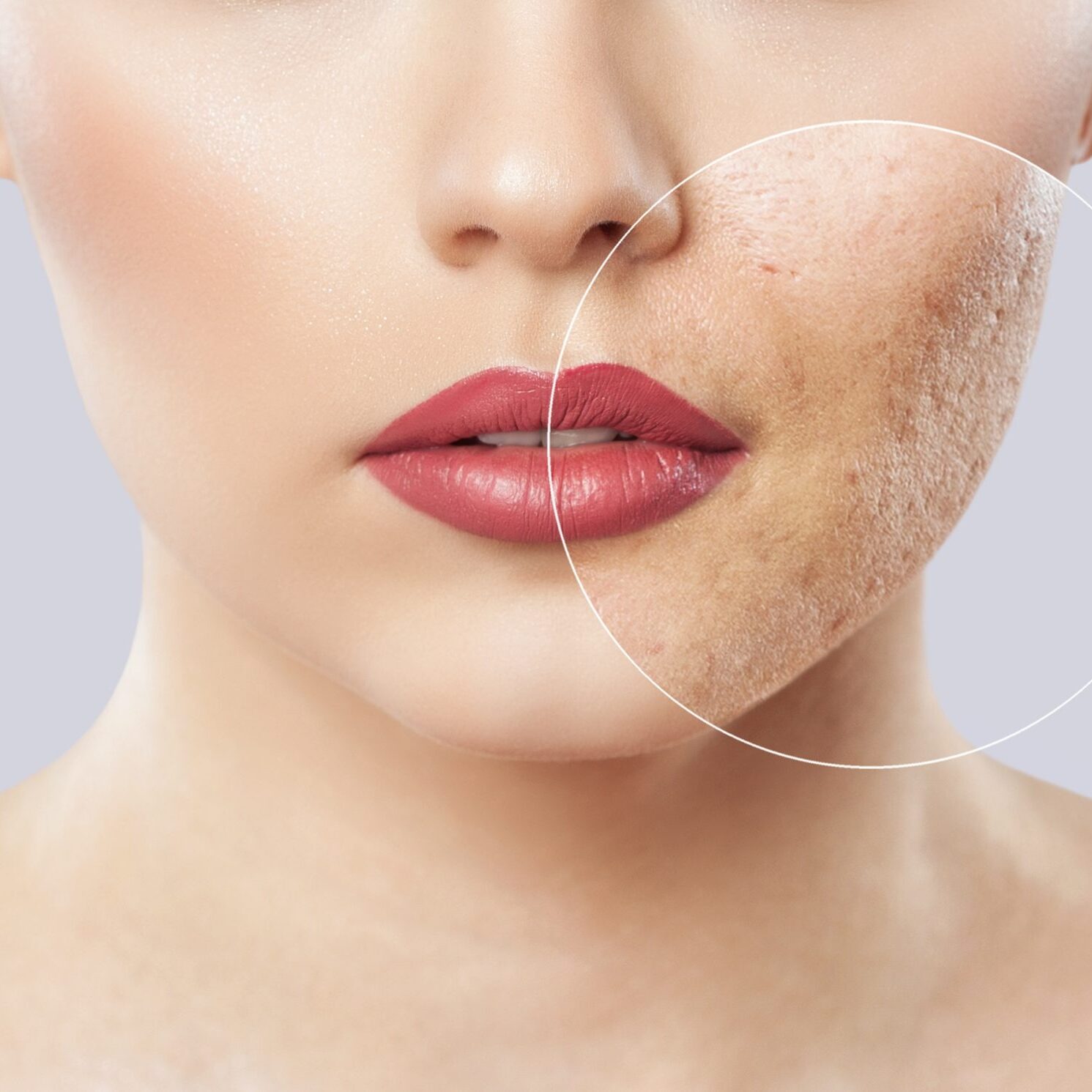 acne-shutterstock_1346981630_250k