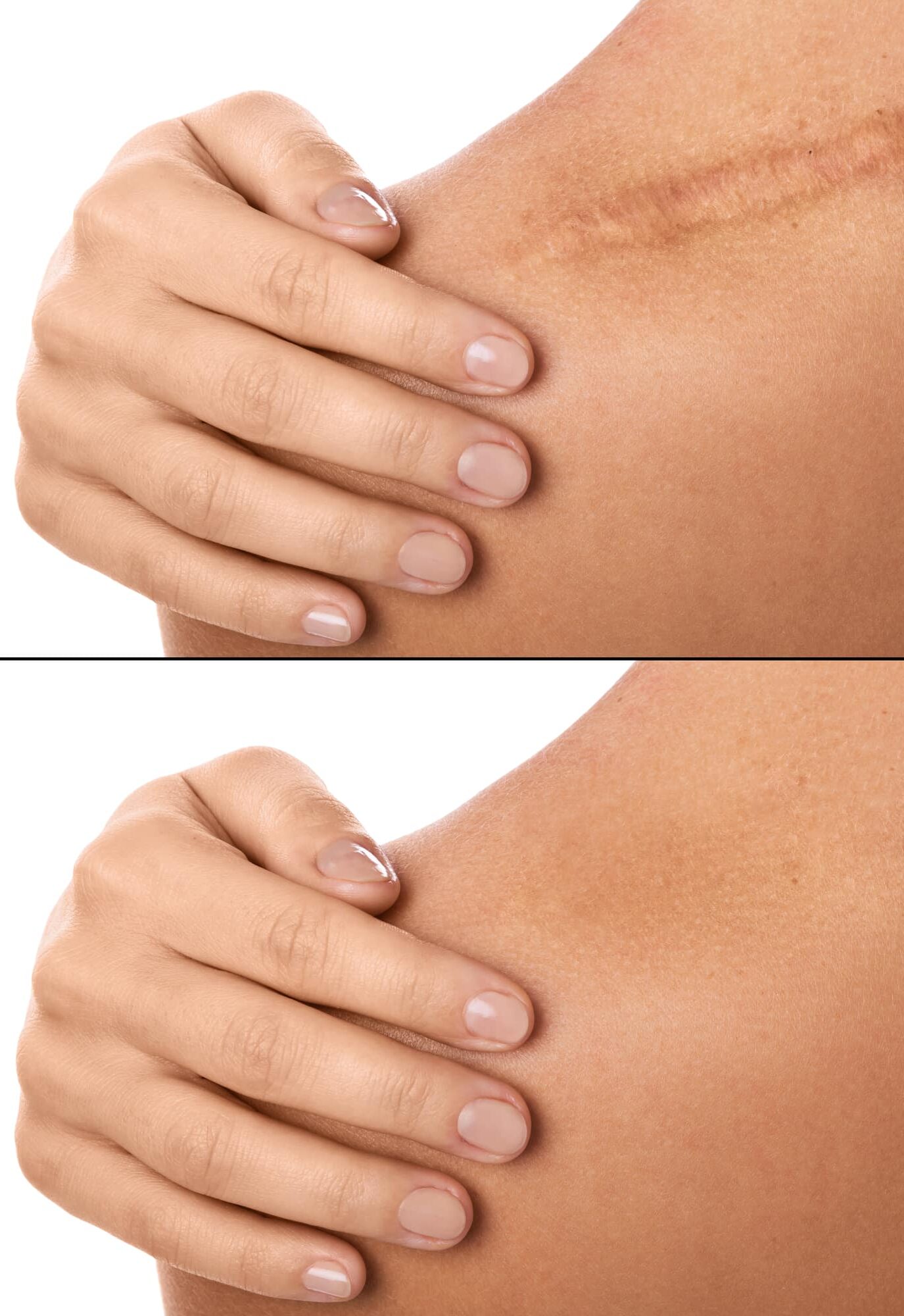 Comparision of female shoulder after scar removing procedure