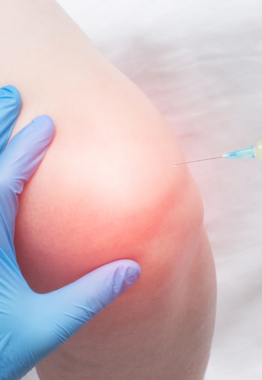 The doctor injects plasma into a sore, inflamed female knee for arthrosis and arthritis, plasma-lifting, close-up, medical, biotechnology