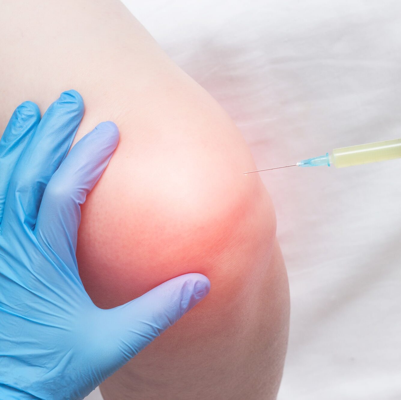 The doctor injects plasma into a sore, inflamed female knee for arthrosis and arthritis, plasma-lifting, close-up, medical, biotechnology