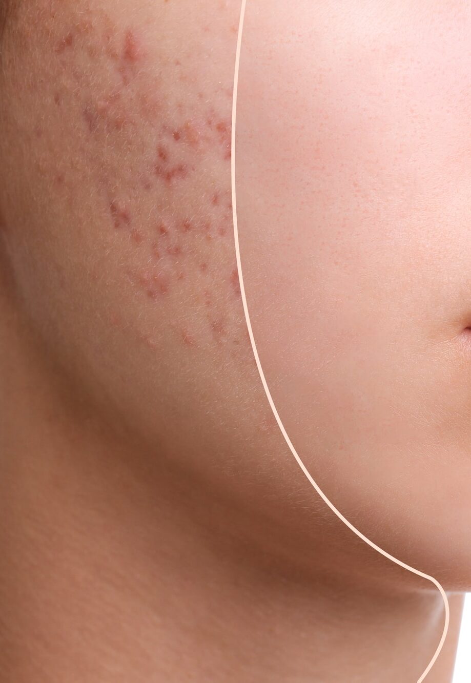 Teenage girl before and after acne treatment on white background, closeup