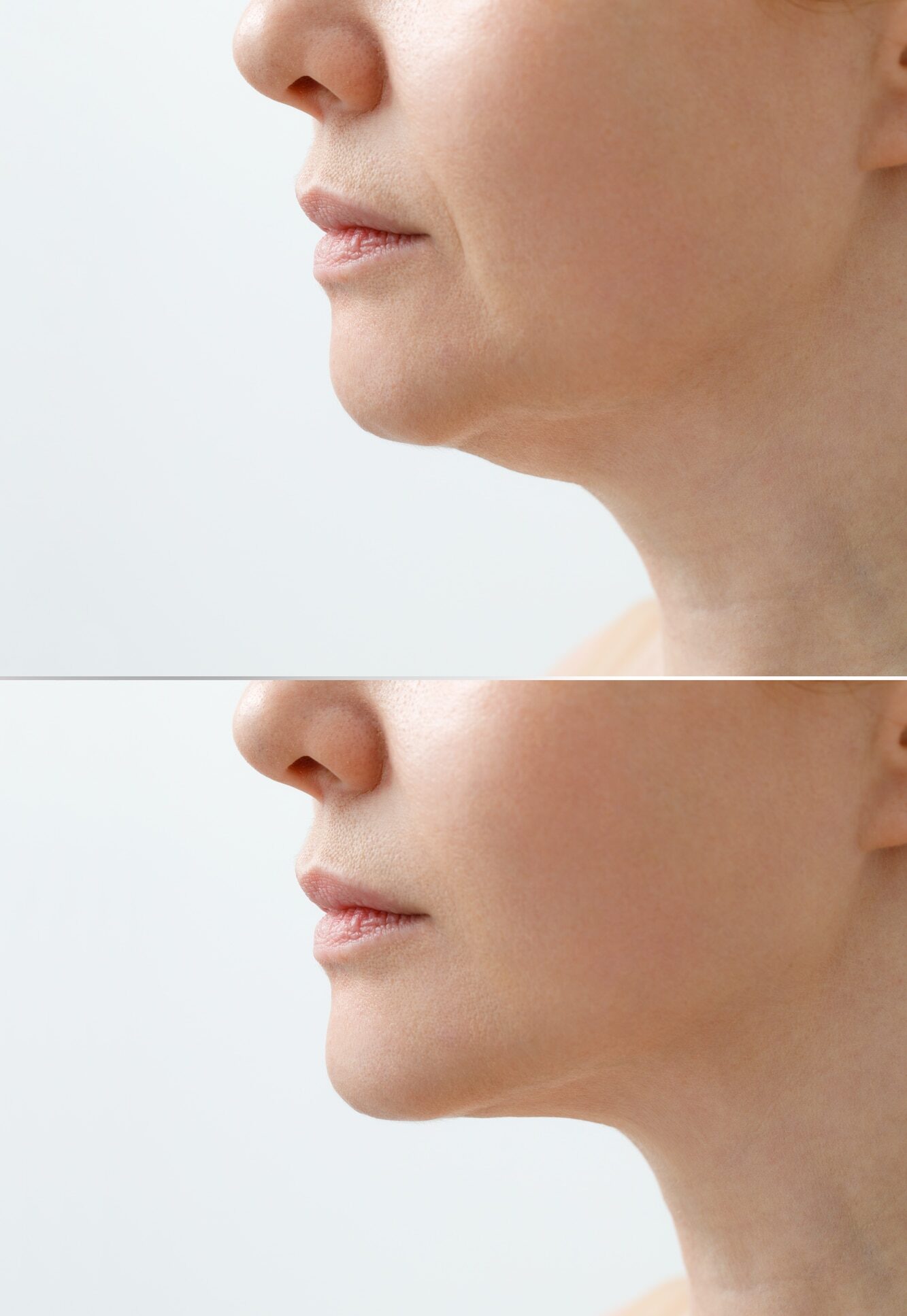 A close portrait of an aged woman before and after facial rejuvenation procedure. Correction of the chin shape liposuction of the neck. The result of the procedure in the clinic of cosmetic medicine