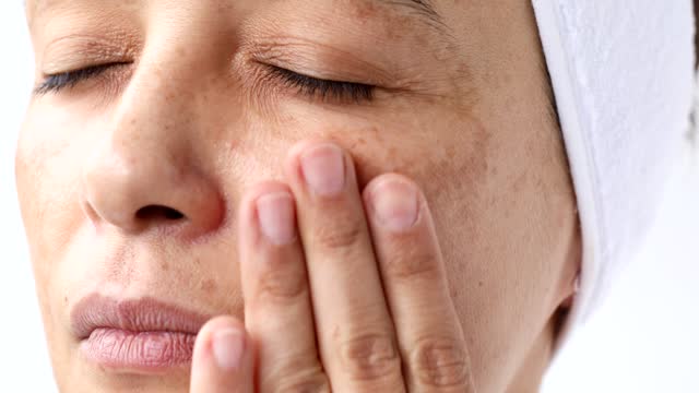 Tackling Melasma from the Inside Out: A Comprehensive Guide