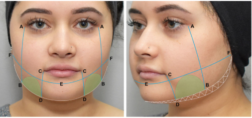 Jowls are those visible bulges that form on the lower jawline, often extending down towards the chin.
