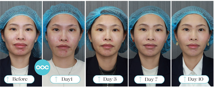 Instant Lift results from day 1 to day 10 after treatment