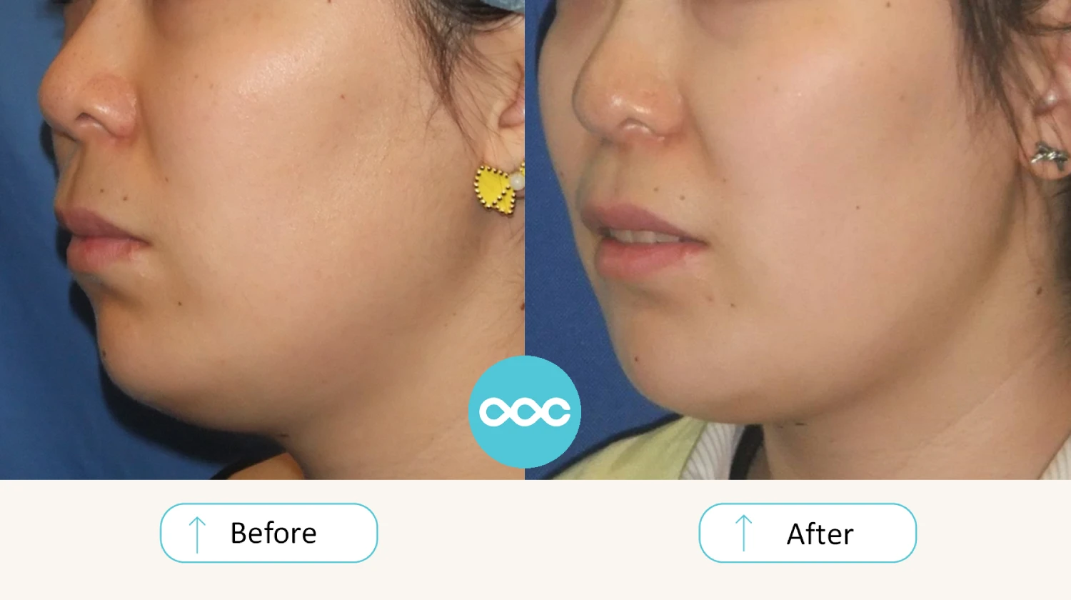 接受 SuperBotox 療程前後的下顎線條對比