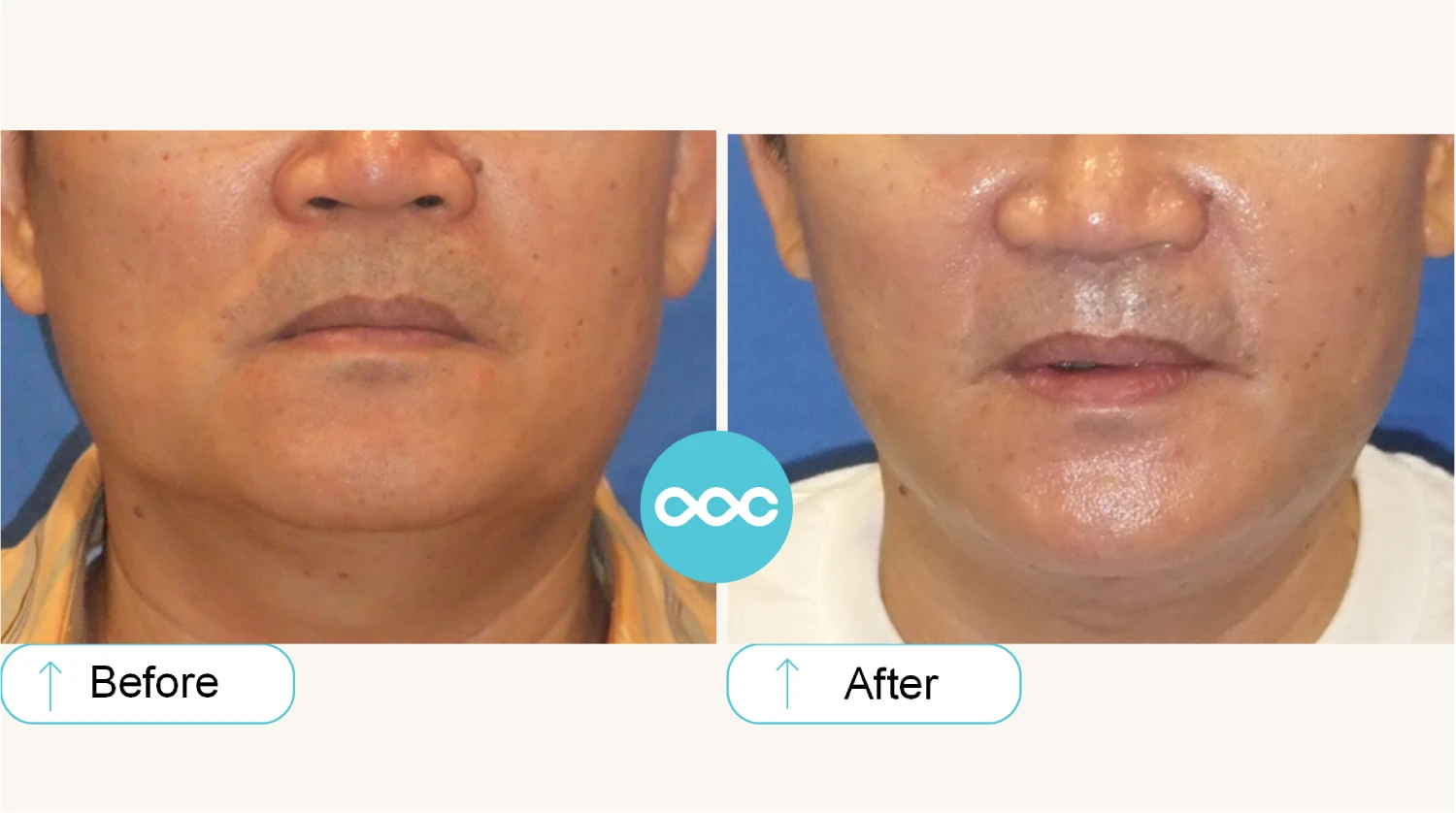 接受 SuperBotox 療程前後的臉部纖細度對比